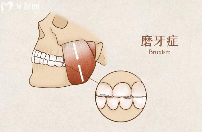 夜間磨牙傷害牙齒嗎