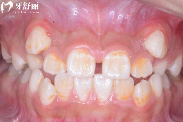 牙齒脫礦是什么原因造成的