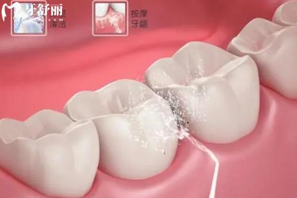 定期潔牙對牙齒有危害嗎？牙齒松動？牙縫變大？真相水落石出