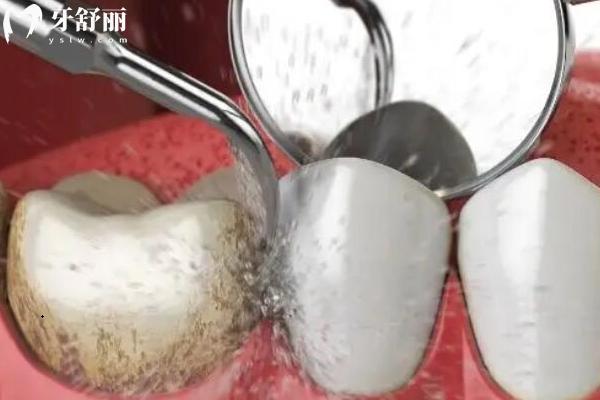 定期潔牙對牙齒有危害嗎？牙齒松動？牙縫變大？真相水落石出