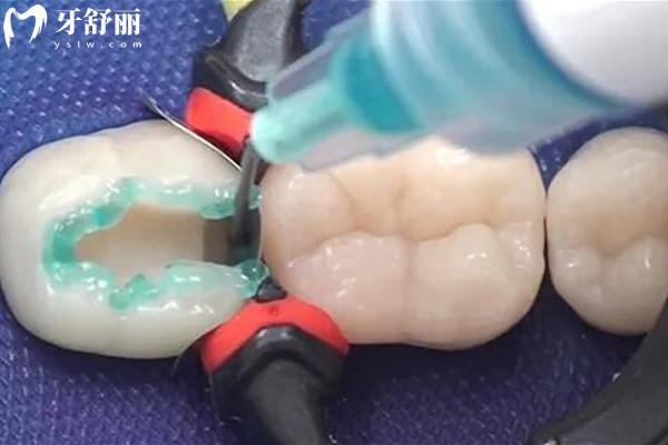 出現(xiàn)蛀牙可以不補嗎？不可以！早治療早**