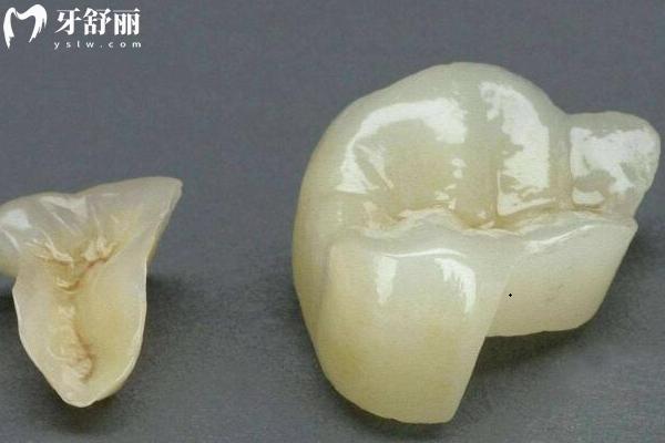出現(xiàn)蛀牙可以不補嗎？不可以！早治療早**