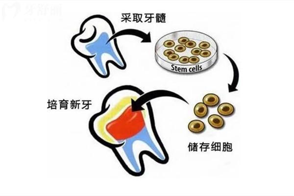 什么是牙髓再生術(shù)