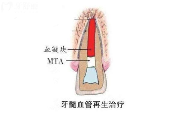什么是牙髓再生術(shù)
