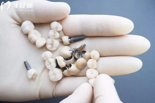 拔牙后多久可以做修復(fù)？修復(fù)方式不同,治療時間也不相同