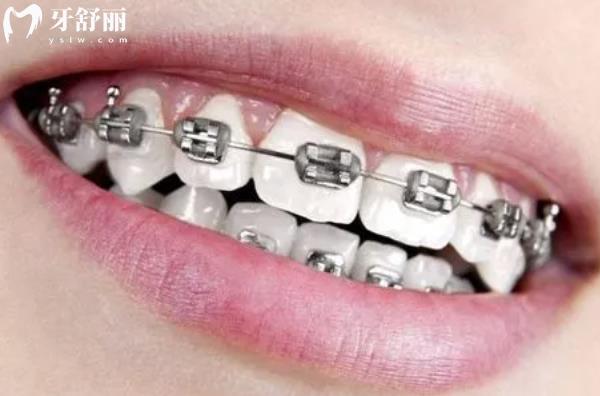 戴牙套有幾個階段？疼不疼？