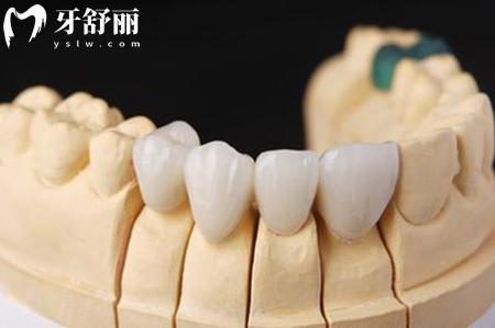 掉了一顆牙怎么鑲牙適合