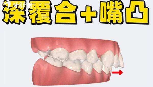 大門牙外凸