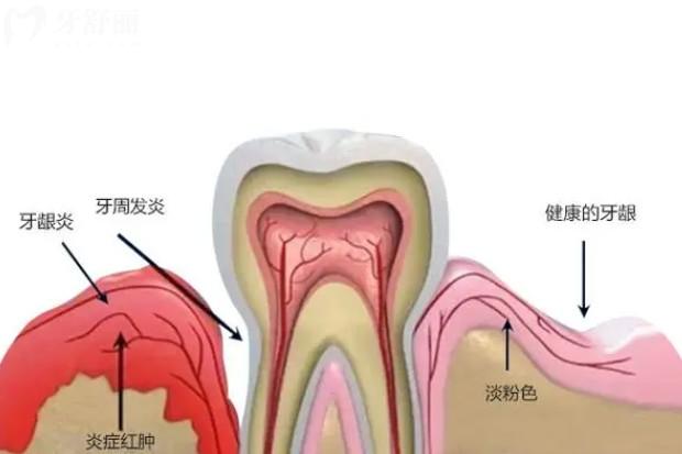 牙周炎