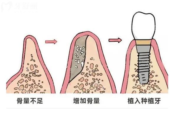 種植牙植骨