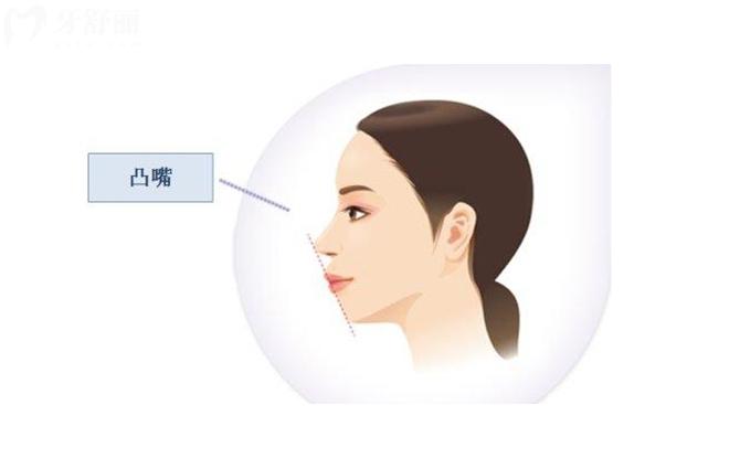 骨性凸嘴帶牙套牙齒矯治器有用嗎？來看看如何矯正