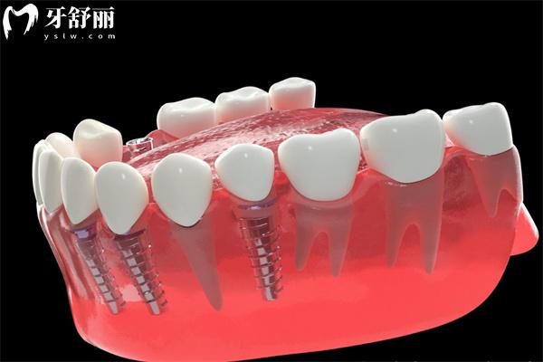 種植牙失敗了費用誰承擔?可以要求醫(yī)院賠償退錢嗎?