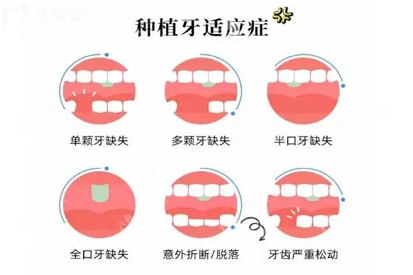 種植牙失敗了費用誰承擔?可以要求醫(yī)院賠償退錢嗎?