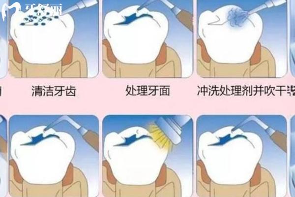 補(bǔ)牙流程和注意事項(xiàng)