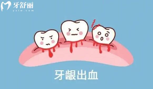預(yù)防牙齦出血的小知識有哪些