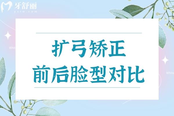 擴(kuò)弓矯正前后臉型對(duì)比