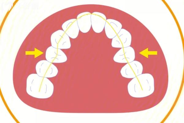 擴(kuò)弓矯正前后臉型對(duì)比