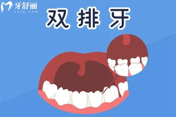 雙排牙為何越來越多了