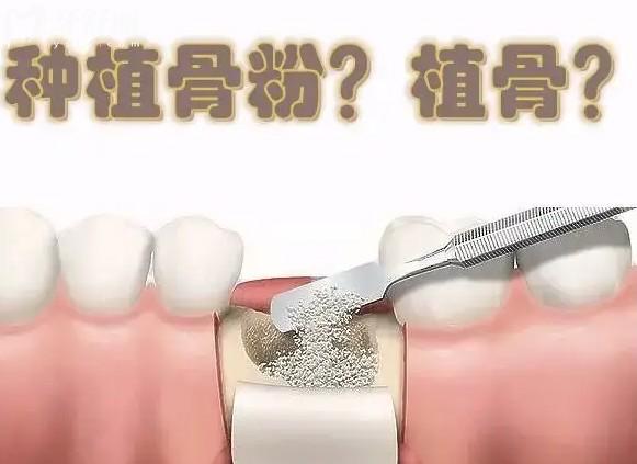 種植牙骨粉價格怎么那么貴