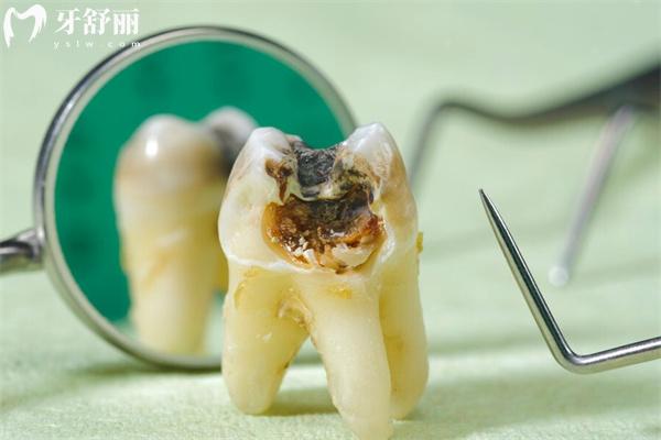 后槽牙爛了千萬別拔