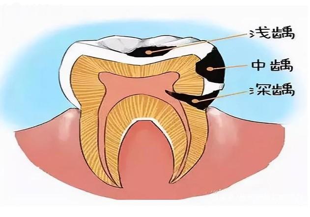 齲病的發(fā)展過程