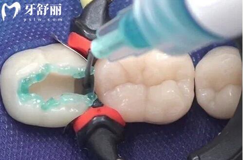 一文詳解：3M樹(shù)脂補(bǔ)牙全攻略,從材料選擇到注意事項(xiàng)