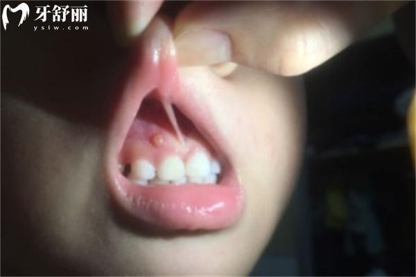 牙齦腫起來(lái)一個(gè)肉包特別疼一按就出血什么原因？
