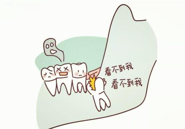 阻生智齒