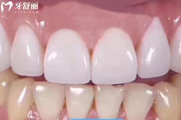 牙貼面做幾顆合適