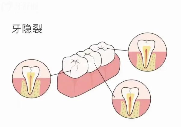 牙齒裂開兩半怎么處理比較好