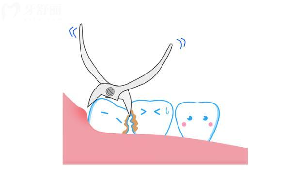 殘牙根不拔可以鑲活動(dòng)假牙嗎