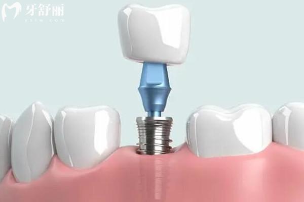 去私人口腔醫(yī)院種牙可靠嗎
