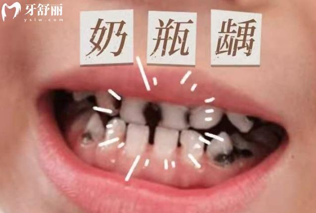 奶瓶齲齒不治療等換牙可以嗎