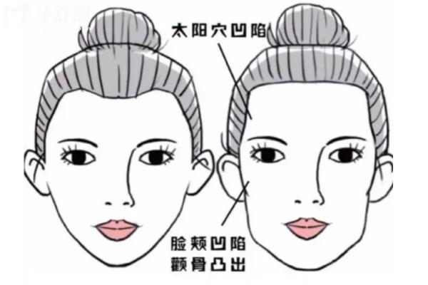 牙齒矯正后怎么更丑了
