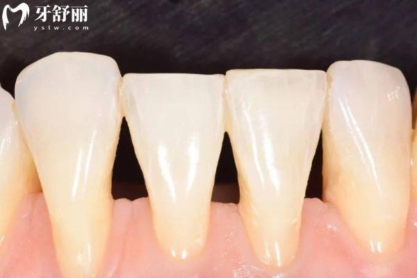 牙齒矯正后怎么更丑了