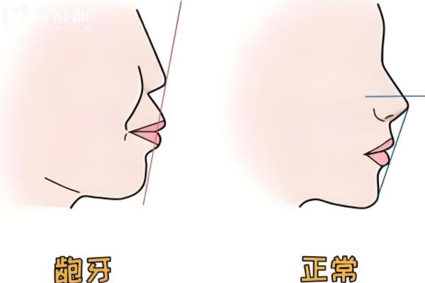 牙齒矯正后怎么更丑了