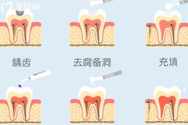 補牙的白色填充物是什么？能堅持多久？附詳細補牙過程
