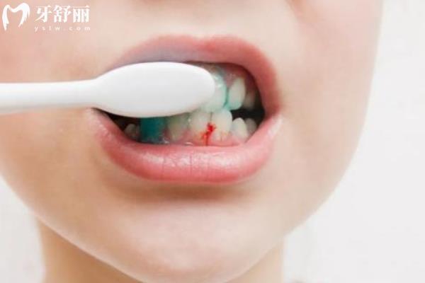 牙齦出血要警惕三種病