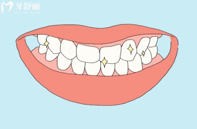 牙齒深覆合會(huì)造成顳下頜關(guān)節(jié)紊亂嗎