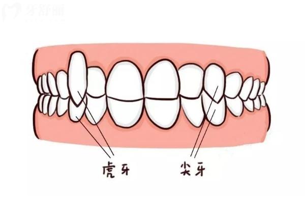 冷知識：虎牙其實是一種牙齒畸形！快讓有虎牙的小伙伴來看看