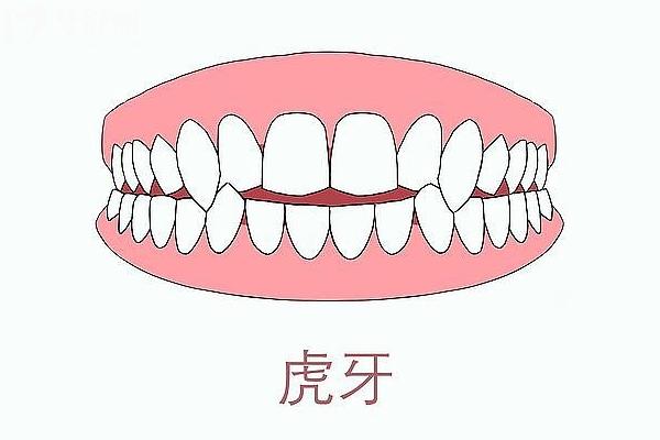 冷知識：虎牙其實是一種牙齒畸形！快讓有虎牙的小伙伴來看看