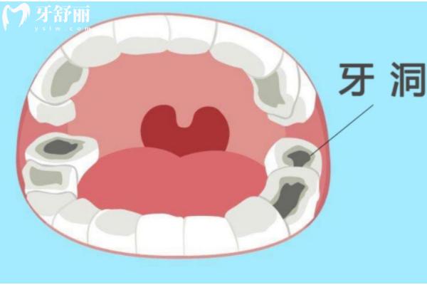 牙洞太大補牙后需要做牙套嗎