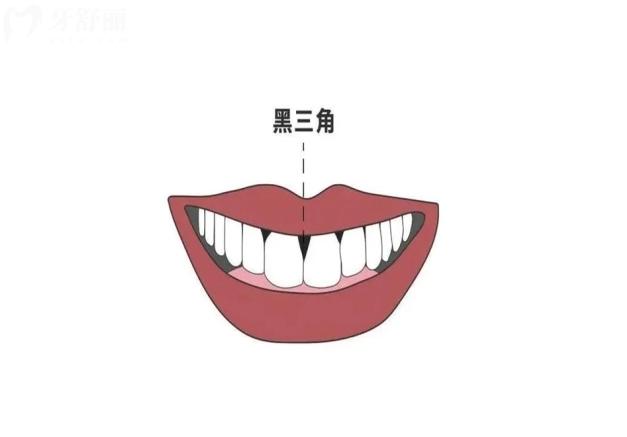 牙齒黑三角怎么形成的
