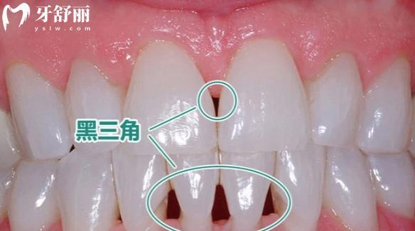 牙齒黑三角怎么形成的