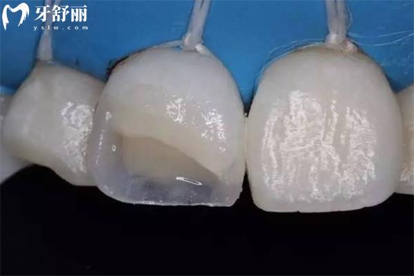 樹脂粘接修復(fù)