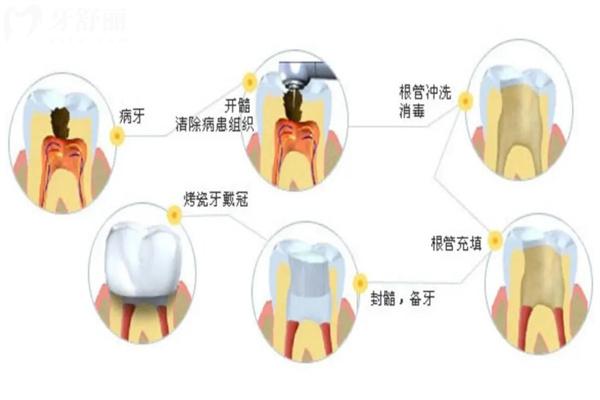 根管治療過(guò)程