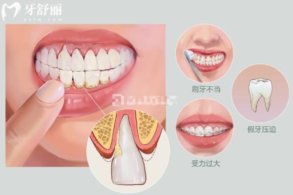 牙齦萎縮和刷牙用力有關(guān)系嗎?