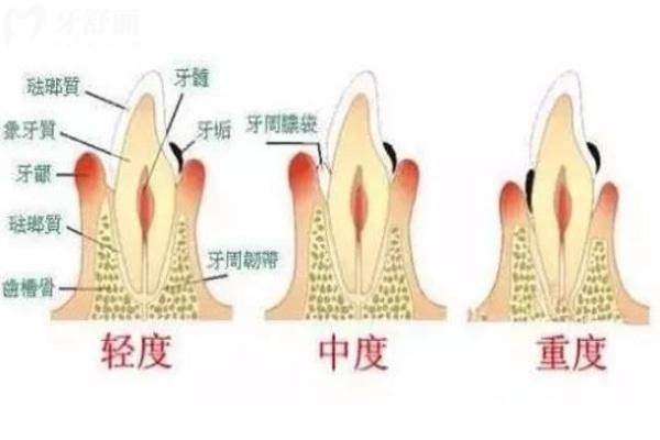 牙齦萎縮和刷牙用力有關(guān)系嗎?