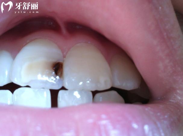 2顆門牙中間內(nèi)部黑了怎么補(bǔ)