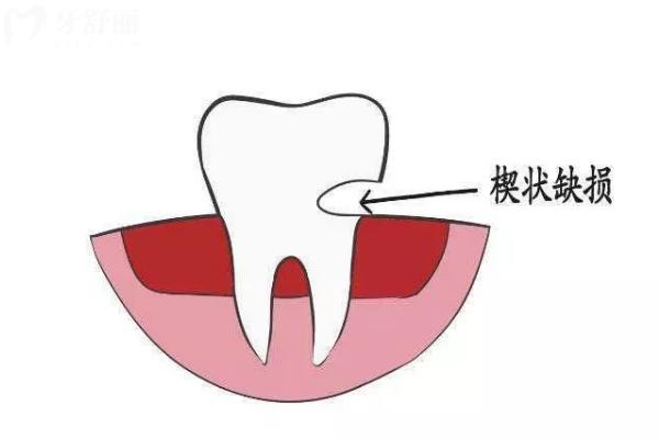 楔形缺損